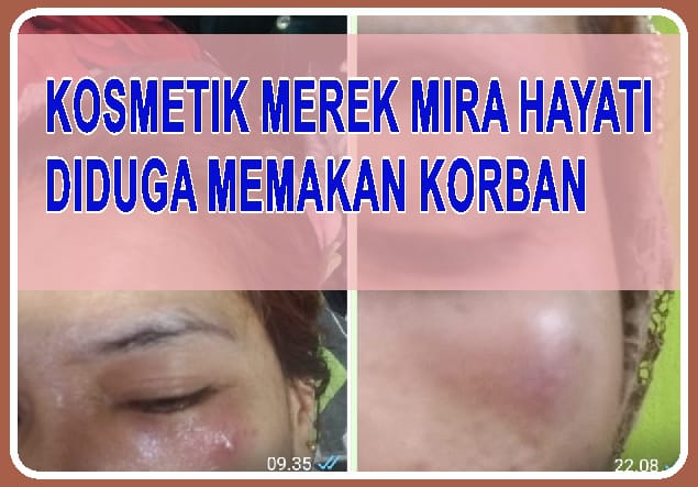Kosmetik Mira Hayati Diduga Memakan Korban, LSM MANDAK Desak BPOM Makassar Jangan Tinggal Diam